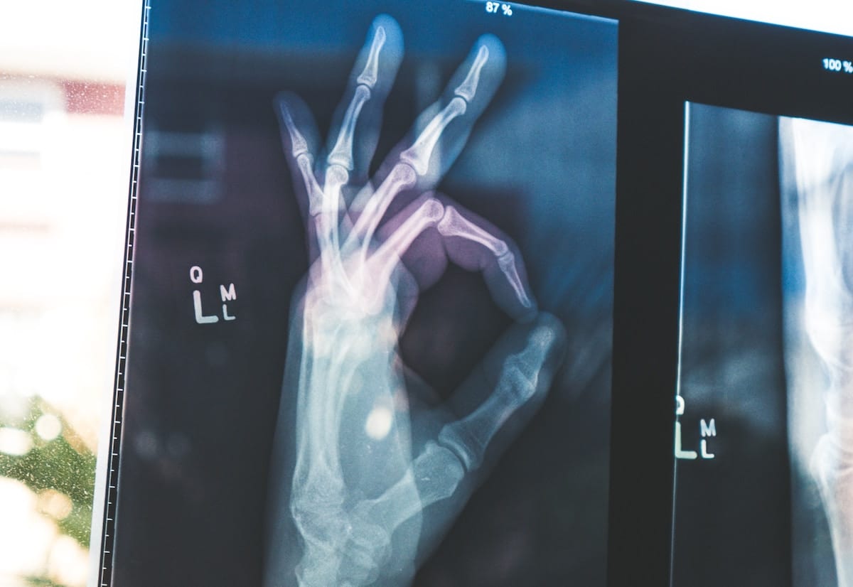 strong bones x-ray